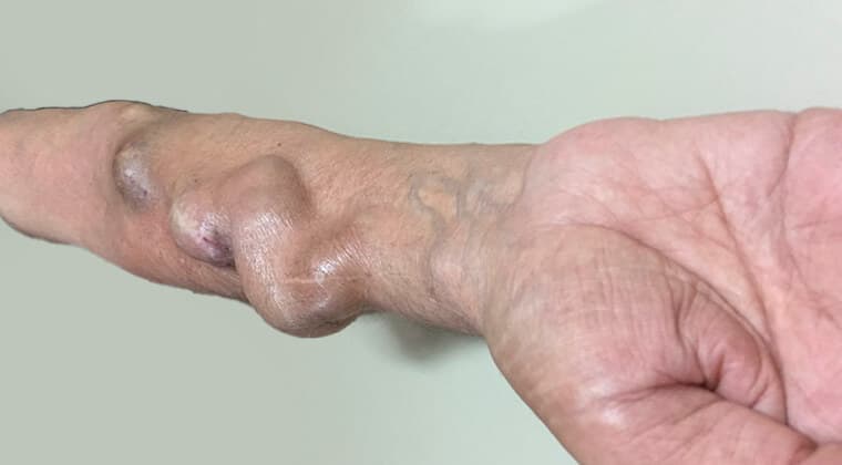 Fístula arteriovenosa