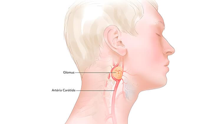 Glomus carotídeo