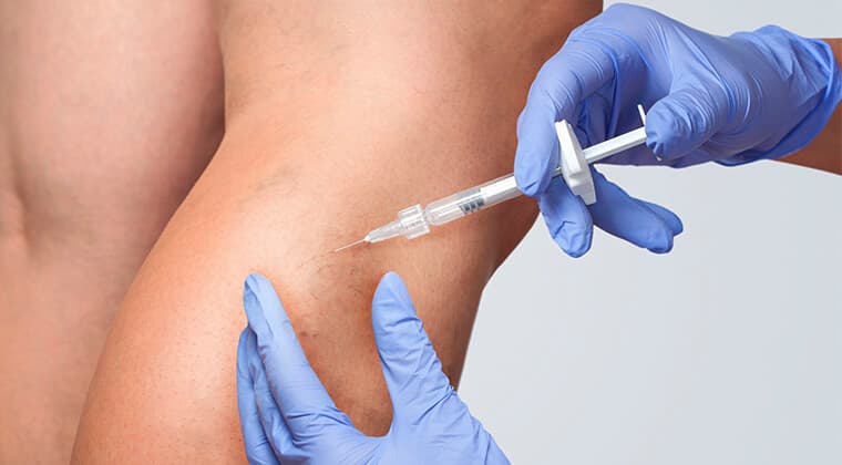 Escleroterapia