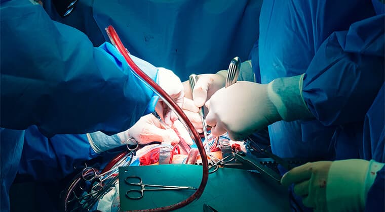 Revascularización con cirugía abierta