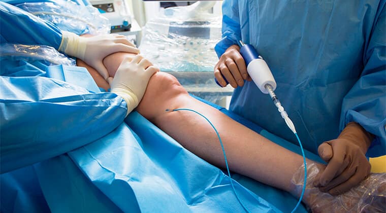Revascularización endovascular