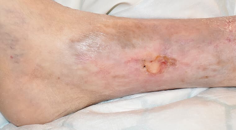 Úlceras o heridas que no cicatrizan